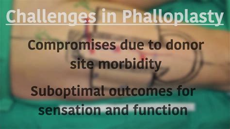 faloplastia|Phalloplasty: techniques and outcomes